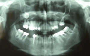 chisturile mandibulare, chirurgie orala Craiova