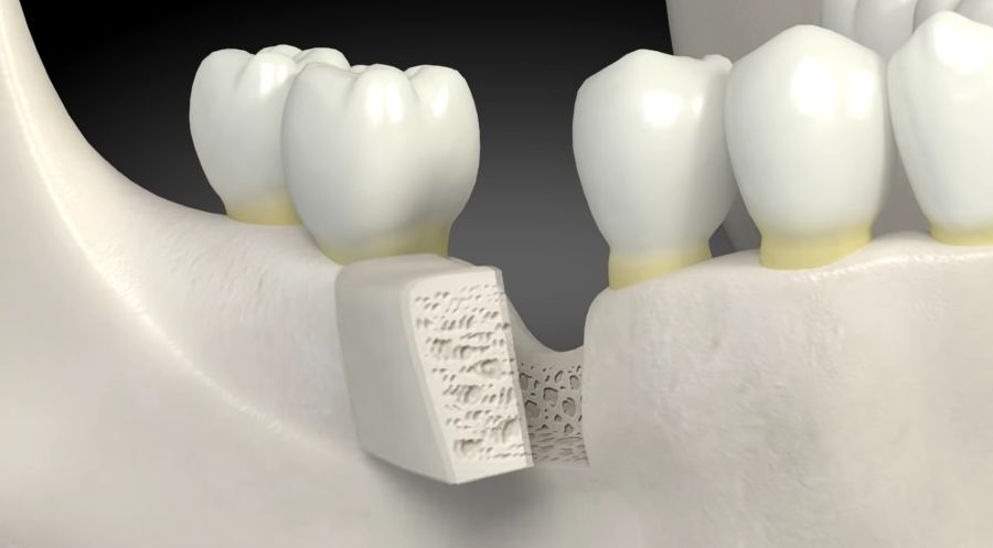 In advance Overtake Articulation implanturi dentare Craiova - Clinica stomatologică CriniDent