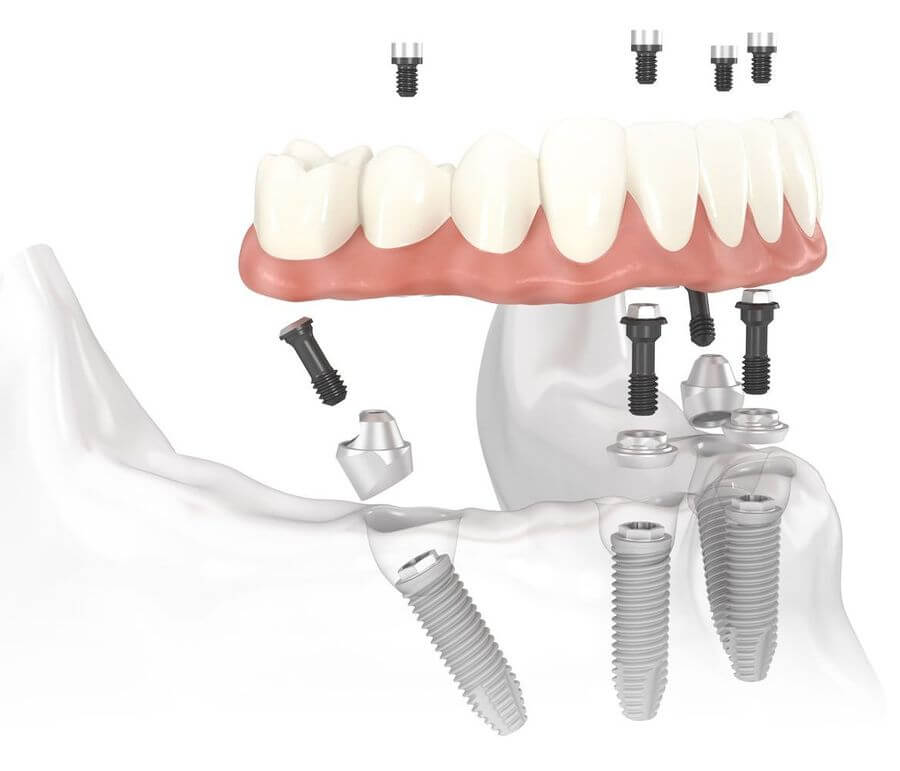 implanturi dentare fast and fixed Craiova