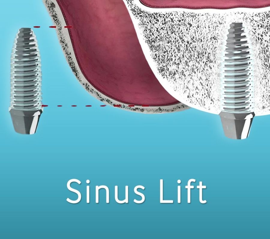 sinus lifting Craiova, clinica dentara CriniDent