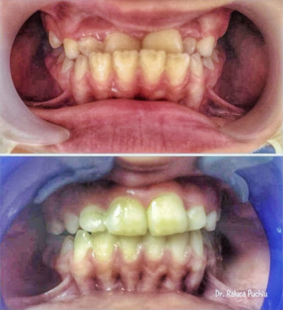 ortopedie dento-faciala - ortodontie Craiova
