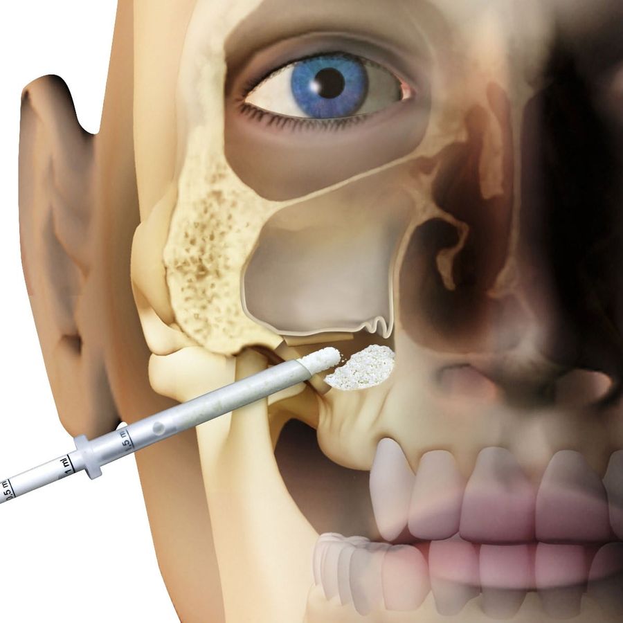 sinus lifting Craiova, chirurgie dento-alveolara