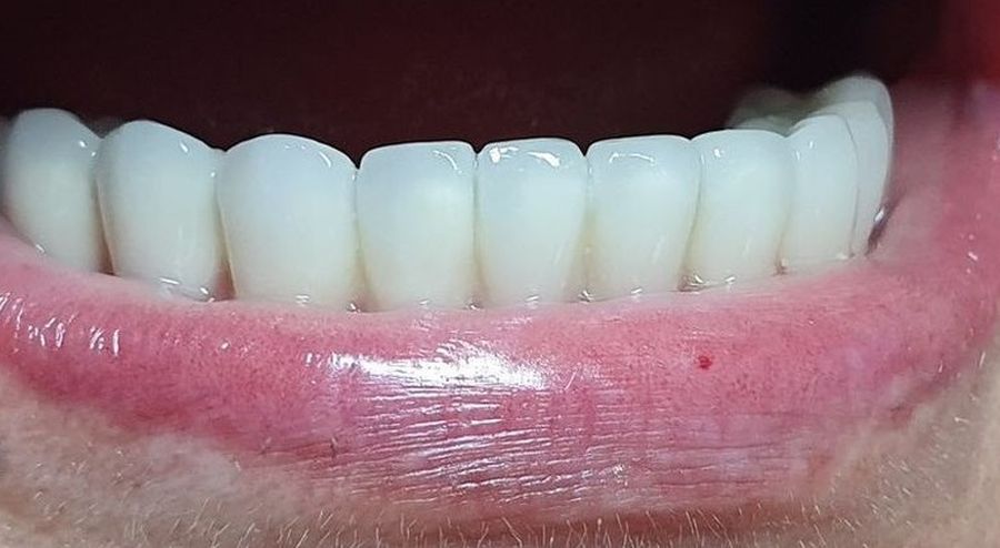 implanturi dentare Craiova