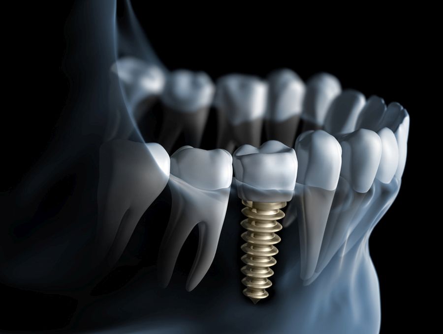 implant dentar Craiova pret