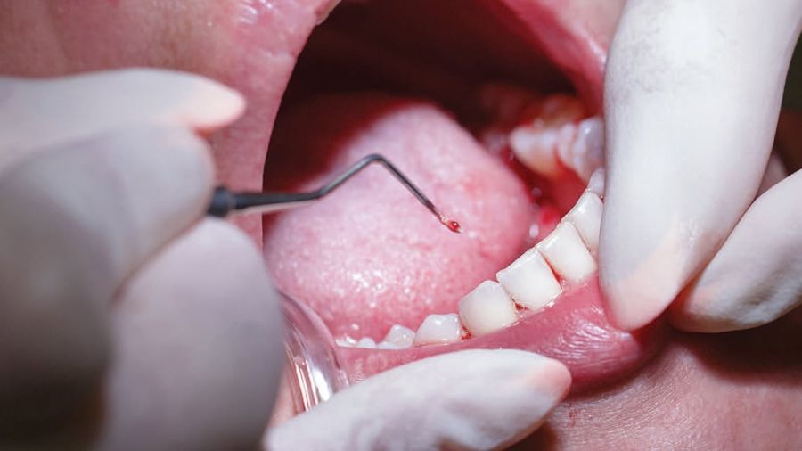 tratament parodontoza Craiova - boala parodontala