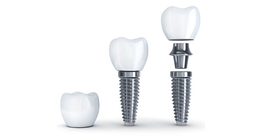 implanturi dentare Craiova Fast and Fixer all-on-4 all-on-6