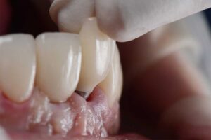 stomatologie Craioca, clinica implantologie implant dentar rapid