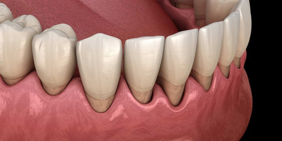 preventie gingivita si parodontoza, parodontologie Craiova