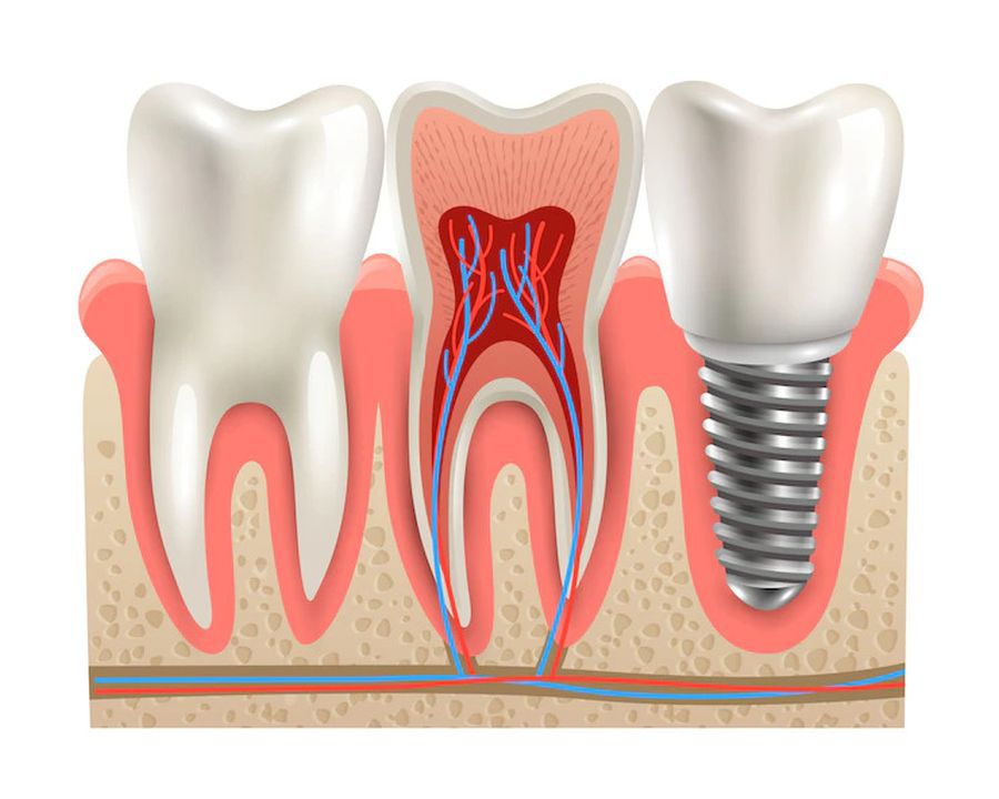 implanturi dentare Craiova, implanturi Fast and Fixed, All-on-4 / All-on-6